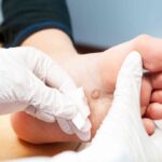 Warts: Types, Causes, and Effective Removal Methods