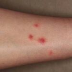 Treatment Of Insect Bites