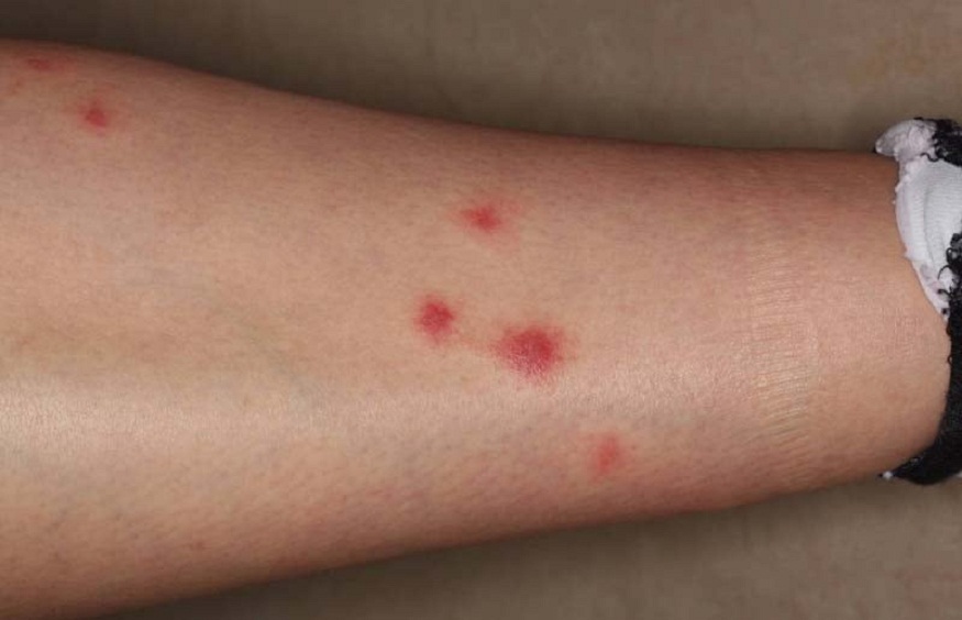 Treatment Of Insect Bites